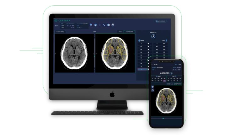 Казахстанский MedTech-стартап Cerebra выиграл конкурс от Johnson & Johnson